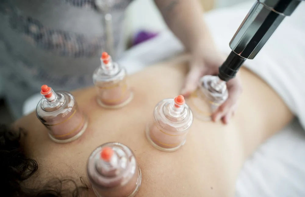 Myofascial cupping